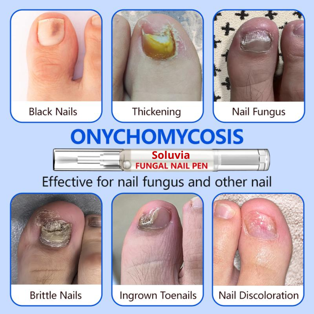 Anti-Fungal Nail Pen
